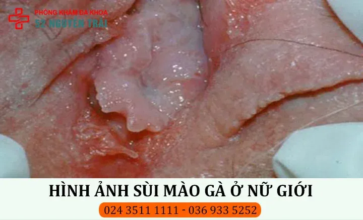Hình Ảnh Nổi Mụn Ở Vùng Kín Nữ - Tuyển Tập 100+ Hình Chân Thực Nhất · ảnh 2