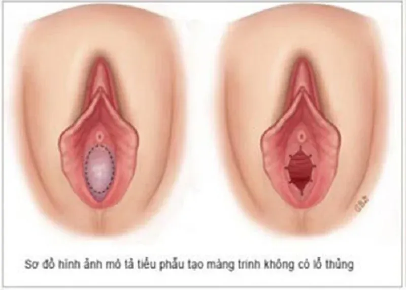 Nhận biết màng trinh còn hay rách: 100+ ảnh tham khảo chi tiết nhất · ảnh 2